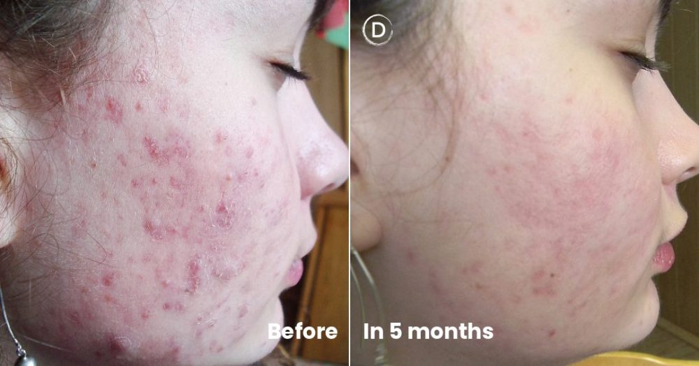 Acne Treatment Specialist in NYC | Dermatology Circle